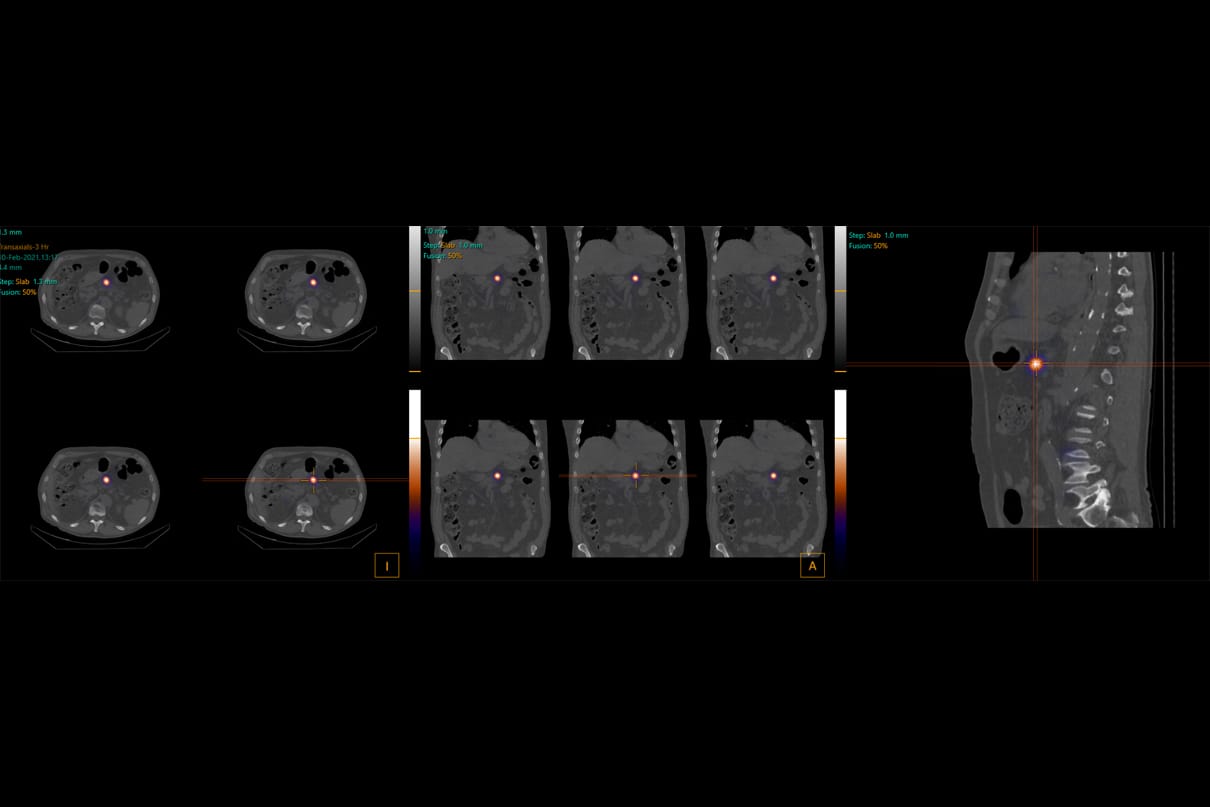 OncoSil tumor reduction scans