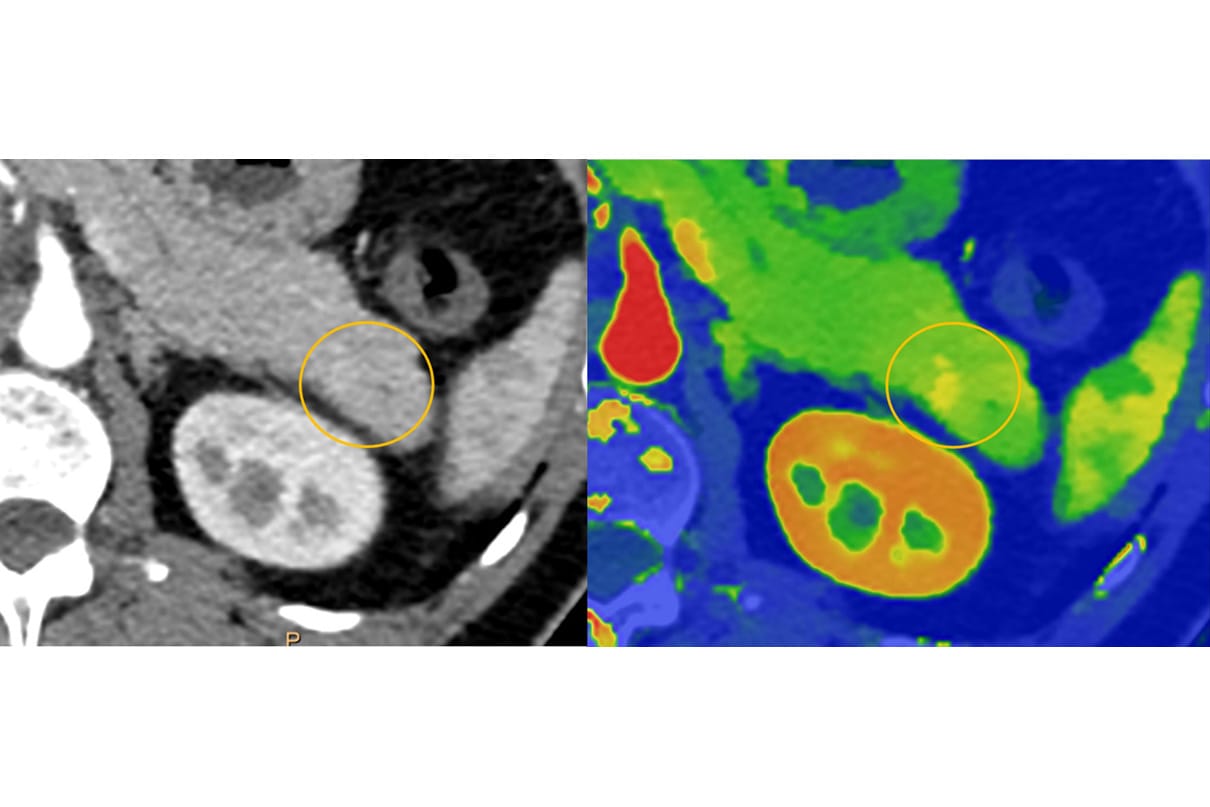 Pancreatic lesion comparison
