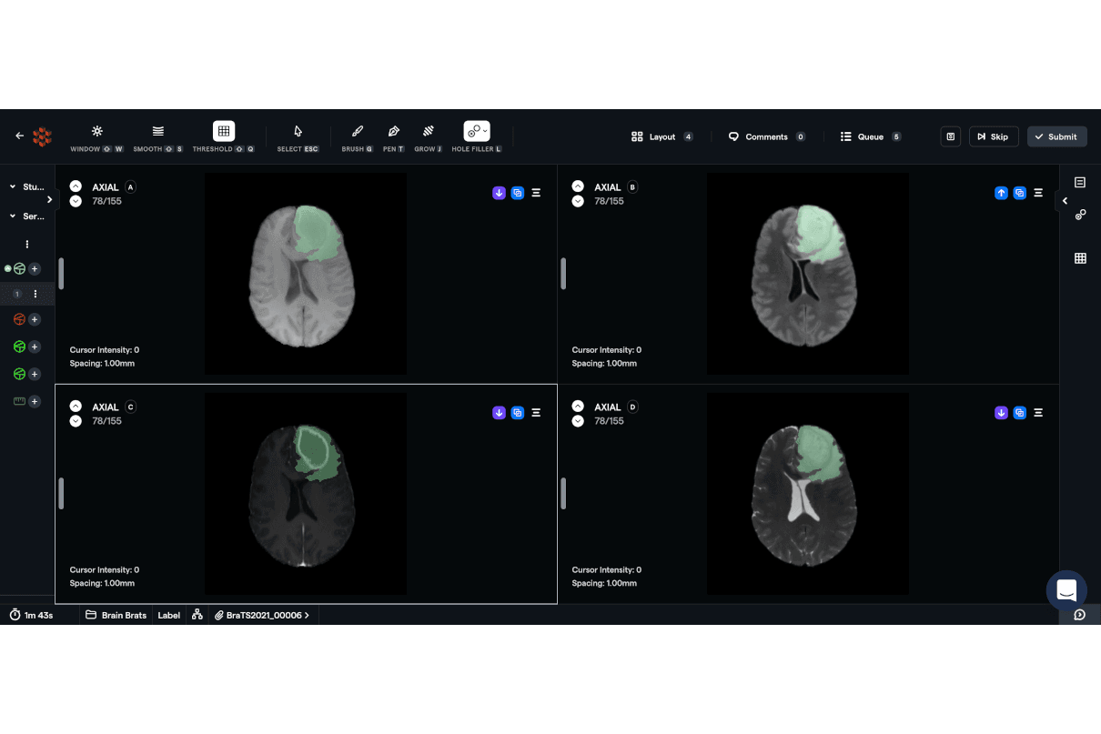 Annotation of a brain bleed in an MRI study.