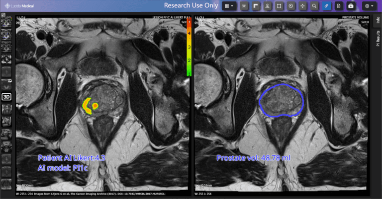 Leeds Teaching Hospitals pilots AI tool for prostate cancer diagnosis ...
