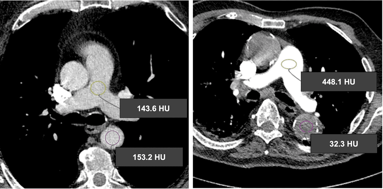 Pulmonary CT with and without Contrast Booster