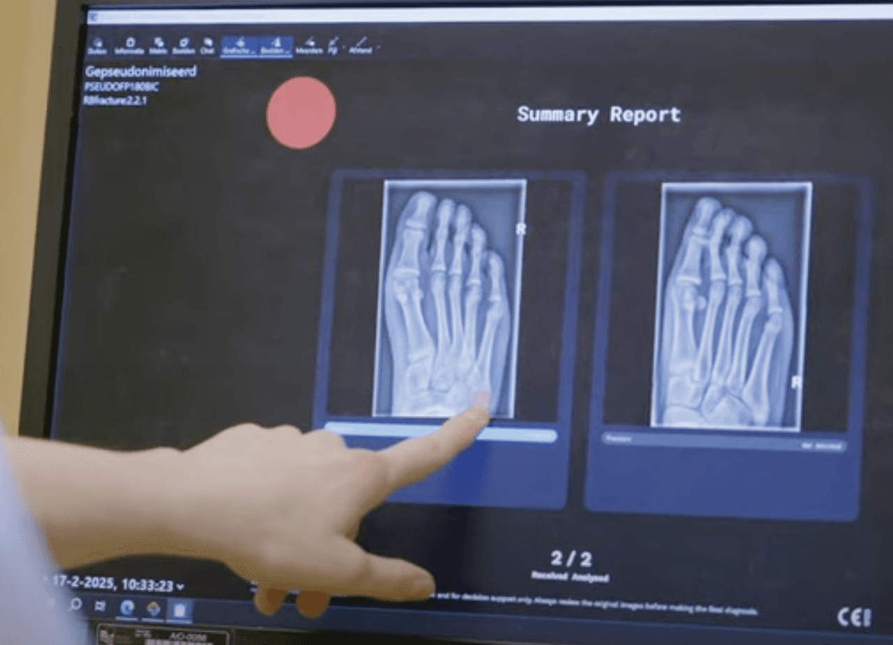 Radiobotics RBFracture