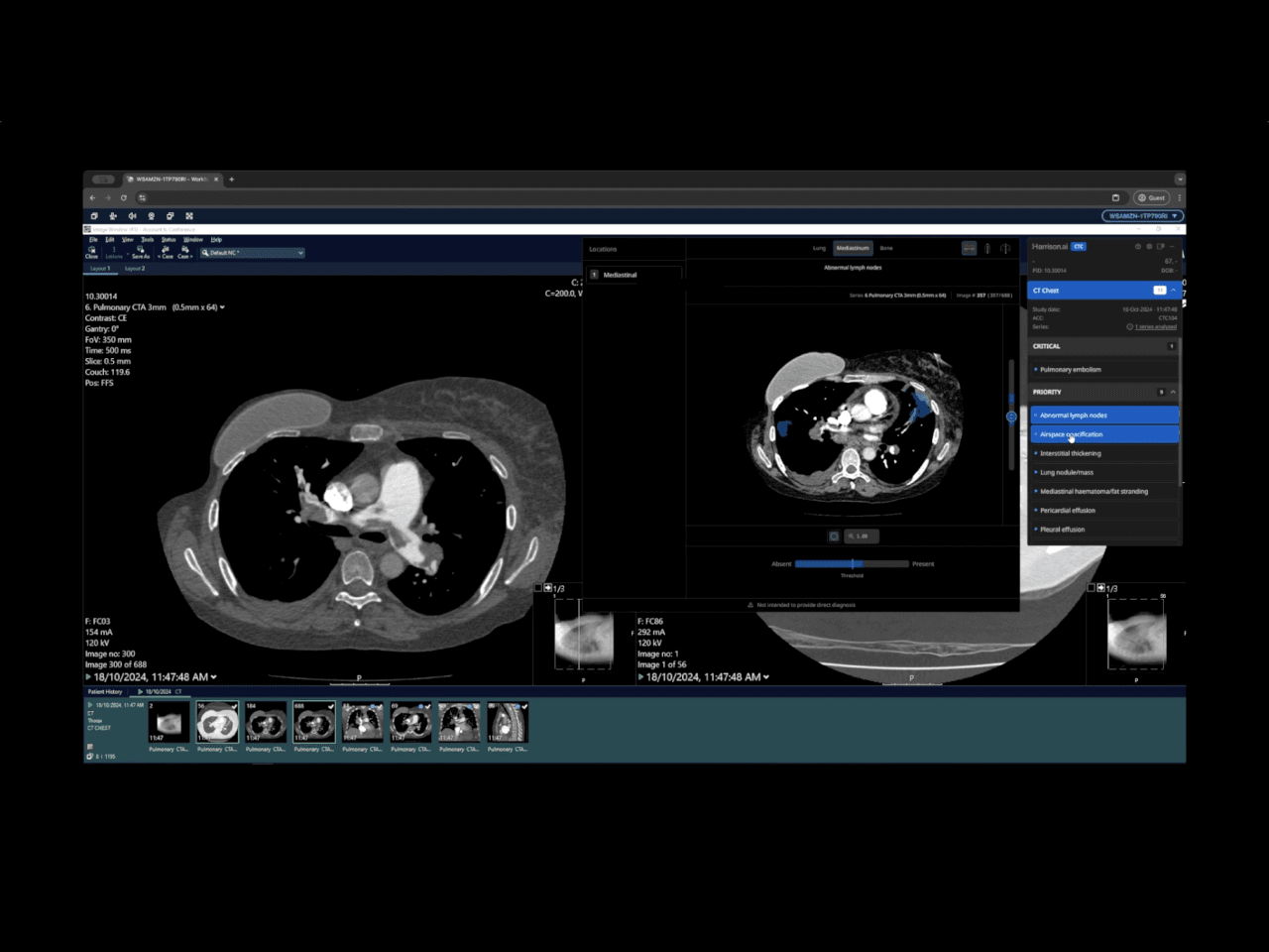 Harrison.ai CT Chest