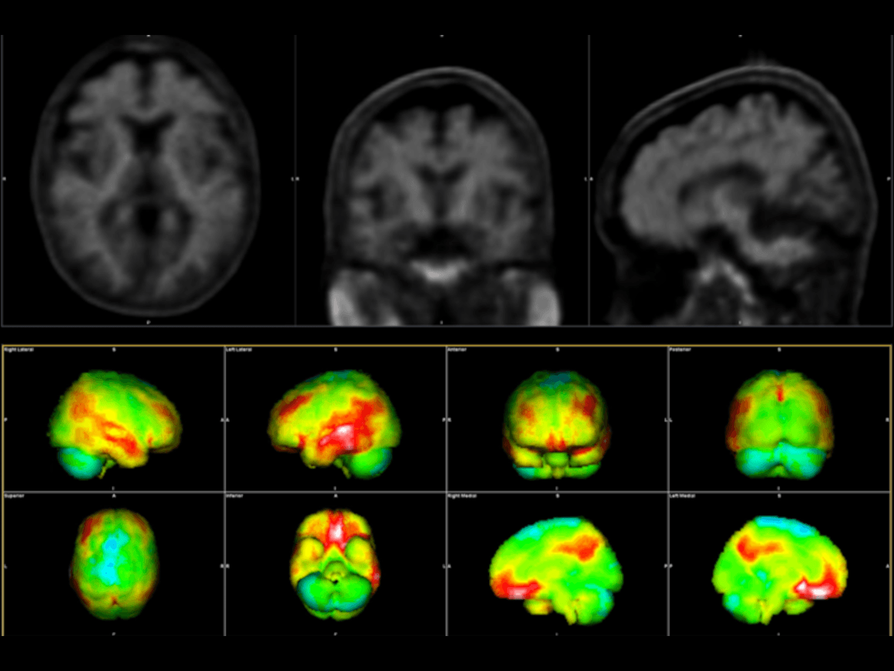 Alzheimer's image analysis