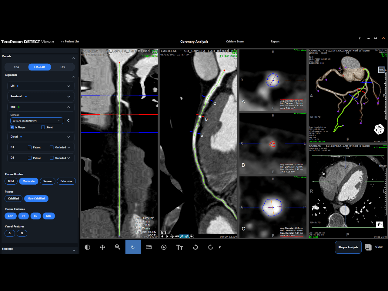 TeraRecon coronary workflow