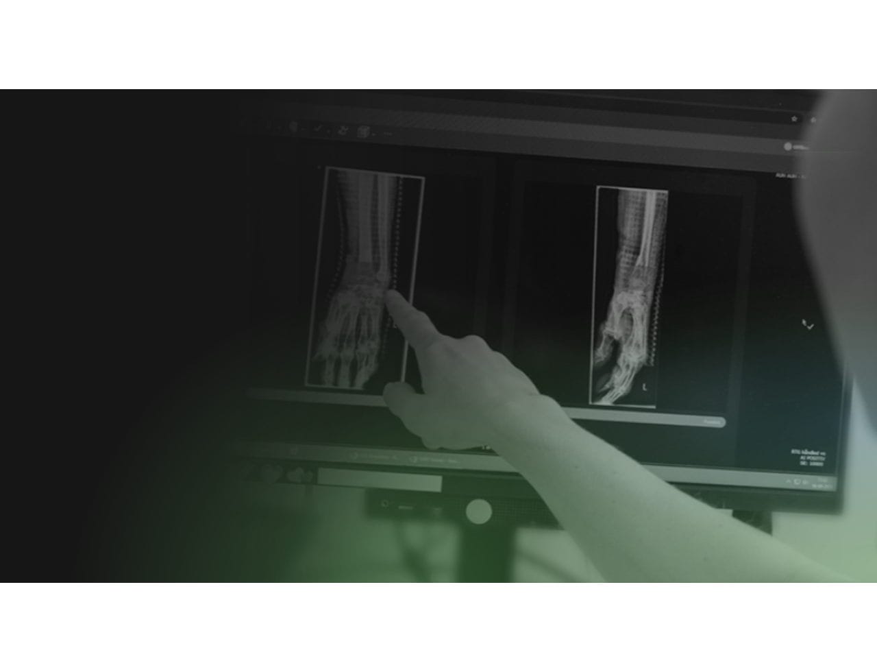 RBFracture